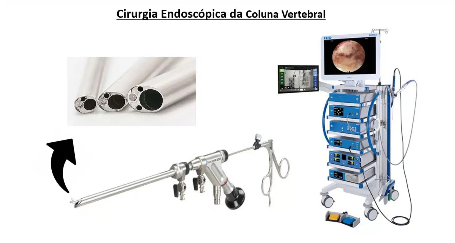 Cirurgia Endosc Pica Da Coluna Vertebral Dr Vin Cius Orso